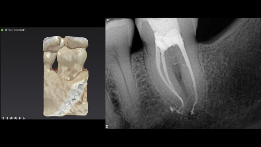Sl. 11a: Rekonstrukcija kosti sa DTX Studio Clinic koja pokazuje defekt kosti u koronarnoj oblasti; Sl. 11b: Rendgen snimak neposredno posle operacije koji pokazuje bočne kanale ispunjene u koronarnom delu distalnog kanala