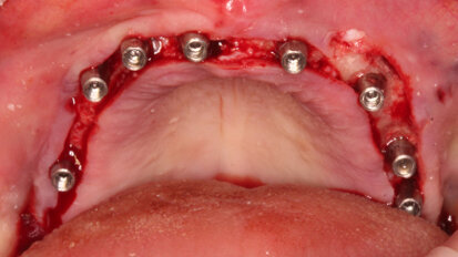 Protesi Toronto con tecnica CLIKSS