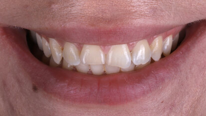 From trauma to harmony: A minimally invasive approach to anterior aesthetics
