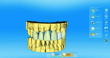 Upotreba  VITA SUPRINITY-  studija kliničkog slučaja