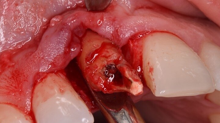 Figura 4. Exodoncia del diente.