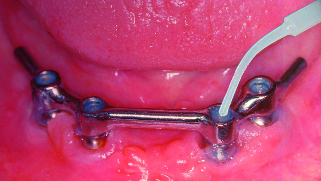 Periodontitis and peri-implantitis prophylaxis through sealing the superstructures