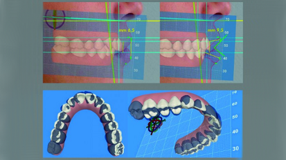 Analyse esthétique dento-faciale au moyen d’un logiciel tridimensionnel (3D) Synergie entre dentisterie esthétique et médecine esthétique