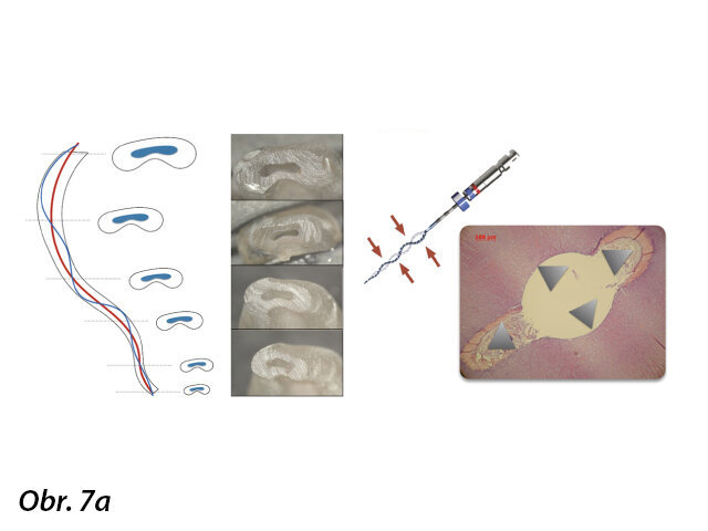 Tradiční NiTi nástroj z kulatého drátu je znázorněn červeně a XP-endo Shaper modrou barvou. Sinusový pohyb XP-endo Shaperu, na rozdíl od kulatého nástroje, který se zavrtává, ukazuje přínos adaptivního debridementu.
