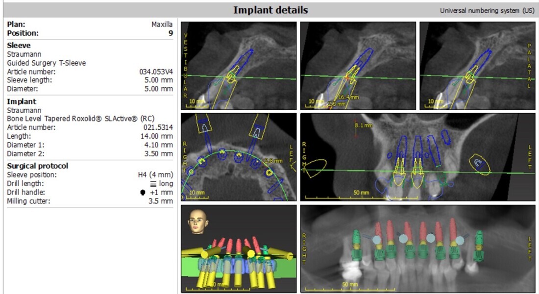 Fig. 12: Maxillary surgical treatment planning using coDiagnostiX.