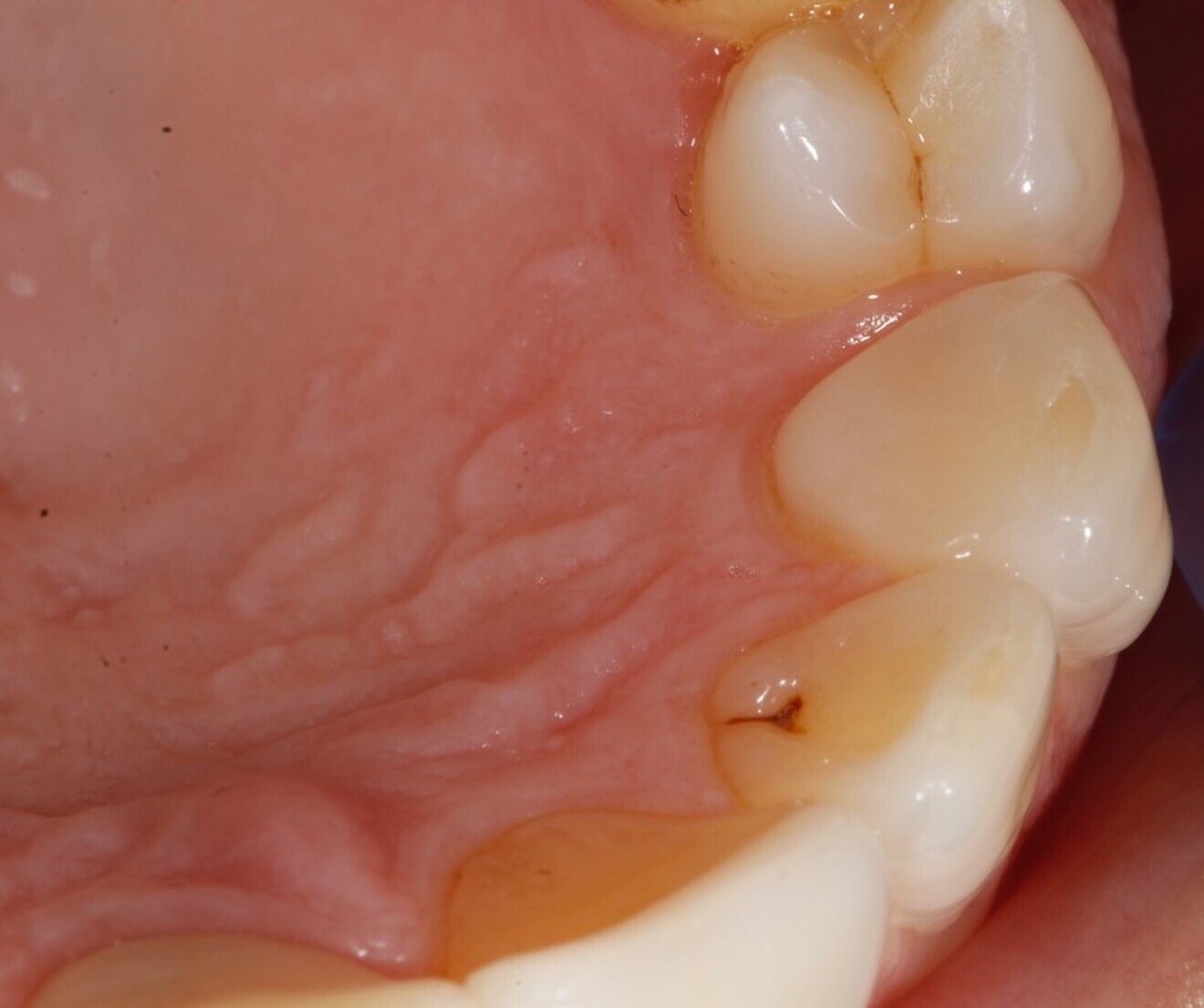 Fig. 15: 2021—the maxillary palatal platforms created with Venus Diamond still functional.
