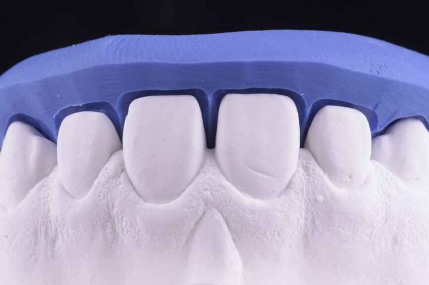 Fig. 35: Sectioned silicone key on the plaster model for laboratory
reduction.