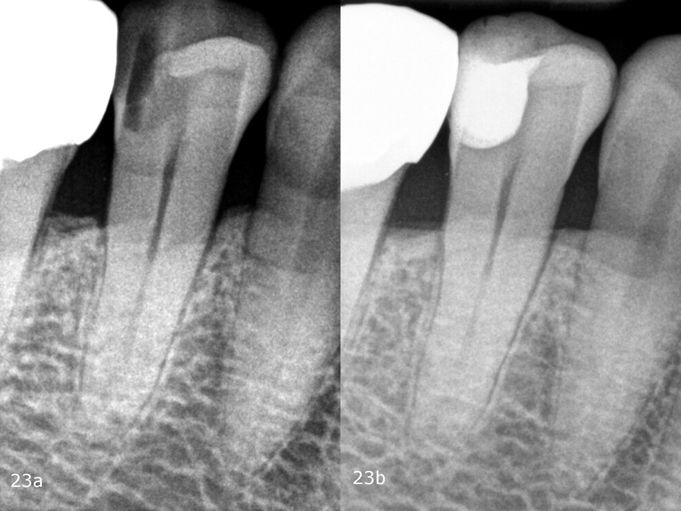 Figs. 23a & b: Pre- and post-op radiograph.
