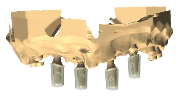 Kompleksowe postępowanie w leczeniu implantologicznym szczęki z zastosowaniem CBCT i CAD/CAM