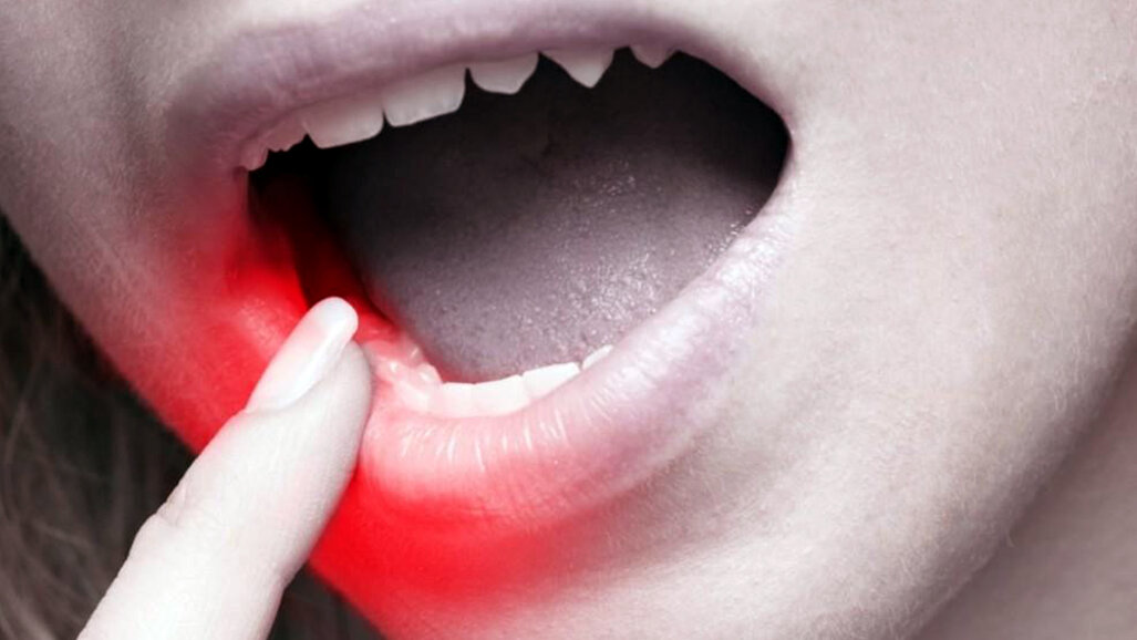 Professional help a must for long-term tooth sensitivity cure