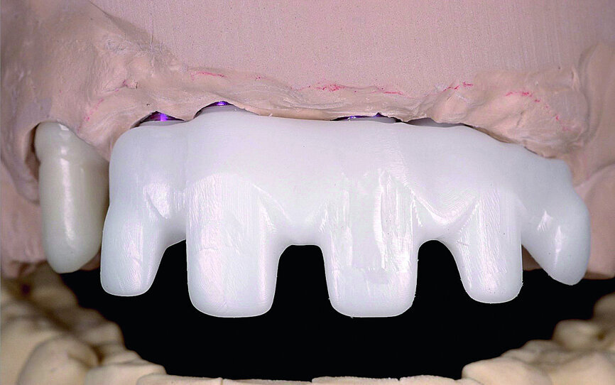 Fig. 33: Final prosthesis framework and the coping for the right canine tested on the working model.