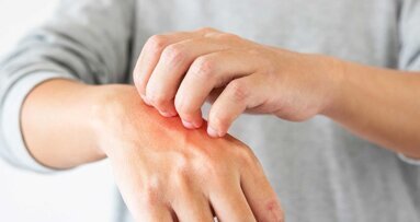 Studie bestätigt Zusammenhang zwischen Zahnagenesie und Dermatitis