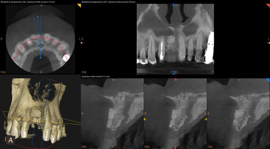 Fig. 1_CBCT (CS9600, Carestream) con field of view (FOV) 10x5 cm dell’arcata rigenerata.