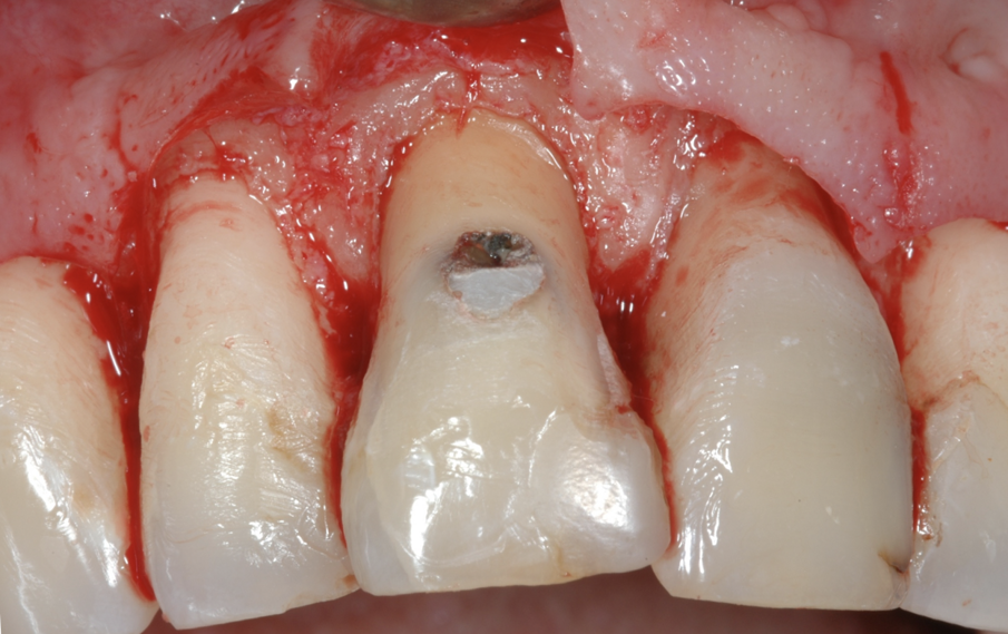 Fig. 6 - La distanza ottenuta tra lesione cariosa e tessuto osseo di circa 3 mm al termine dell’osteo-plastica e ostectomia in prossimità dell’11, con una leggera riduzione in senso buccale della sporgenza della radice.