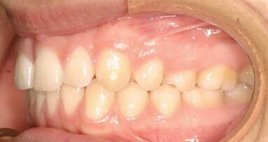 Posibilidades terapéuticas del Clear-Aligner