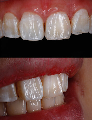Fig 13a & 13b: Immediate post-op