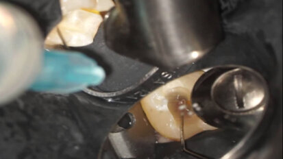 R-SWEEPS endodontic treatment