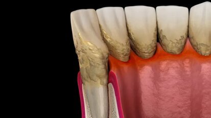 Нова система за прилагане на антибиотици при лечение на агресивен пародонтит