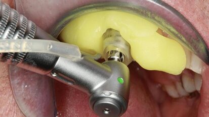 One-visit guided treatment thanks to CAD/CAM and CBCT