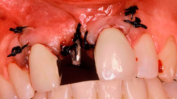 La tecnica del carico immediato con impianti one-piece stabilizzati con ago sincristallizzato: case report