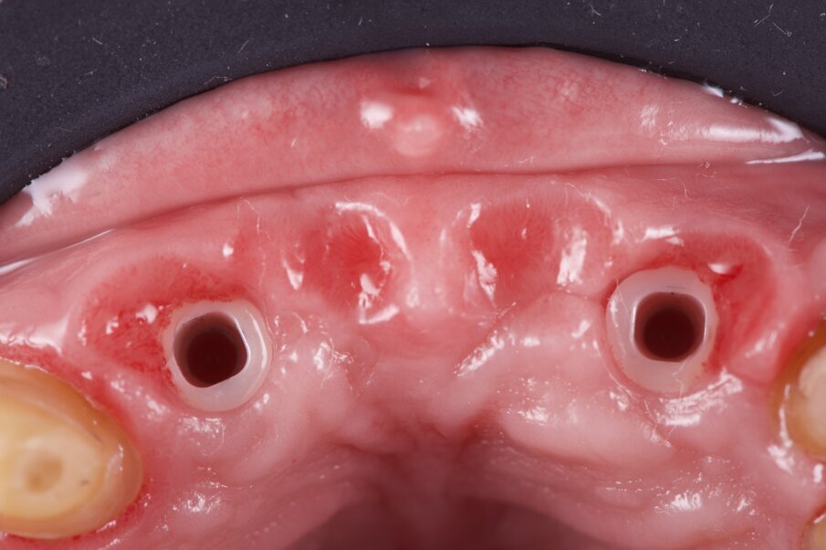 Fig. 30_Dopo un breve periodo di condizionamento è possibile valutare le fovee mucose ovattate e il supporto pericoronale.