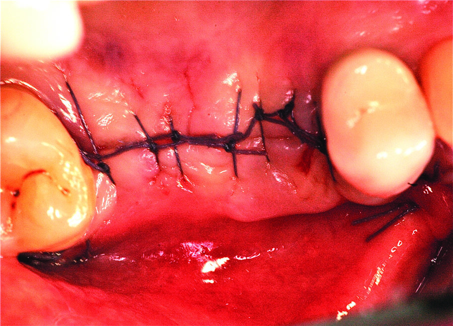 Fig. 12_Particolare della sutura.