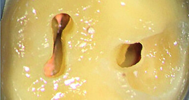 Préparer les cavités d’accès endodontique – Pour des résultats à long terme