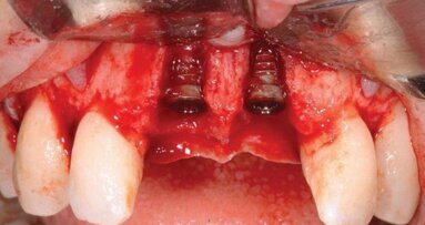 Odbudowa siekaczy centralnych: implantacja, przeszczep kości i tkanek miękkich