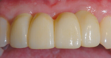 From intraoral scan to final custom implant restoration