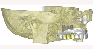 Materialise Dental is celebrating 20 years of 3-D Digital Dentistry