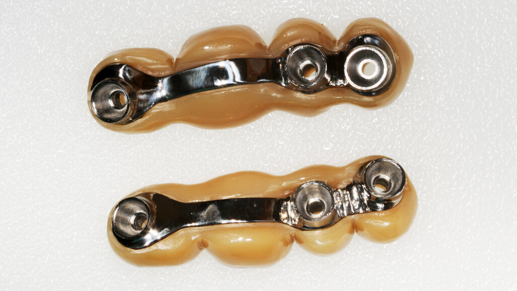 Okamžité zatížení implantátů v distálním úseku horní čelisti dvěma šroubovanými můstky vyrobenými digitálním pracovním postupem