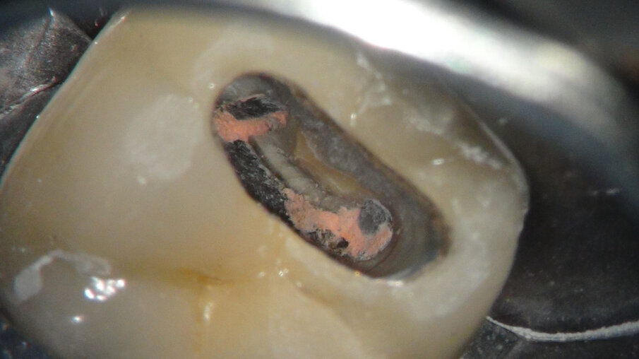 Afbeelding 8. Na anesthesie en rubberdam maken we de access.