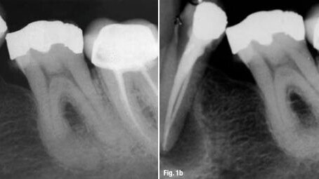 Endodontie : est-ce l'affaire de la biologie ?