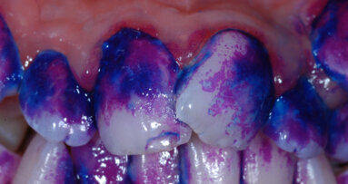 Nuove frontiere per la gestione della placca batterica: rivelatori di placca a confronto