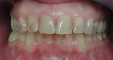 Sobre las carillas cerámicas