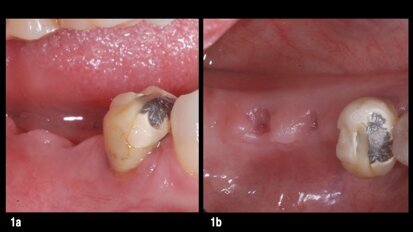 Restauración protésica sobre implantes desconocidos Restauración protésica sobre implantes desconocidos