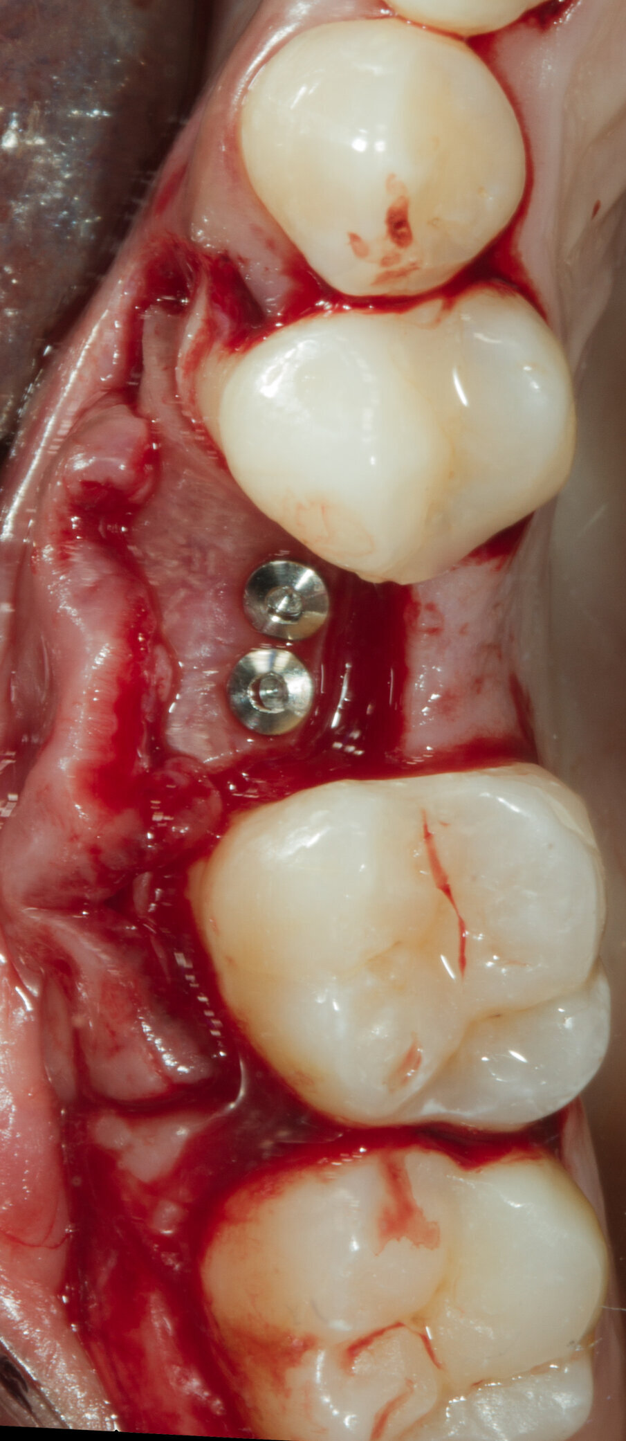 Fig. 12 - Fissazione della Lamina con 2 viti da osteosintesi.