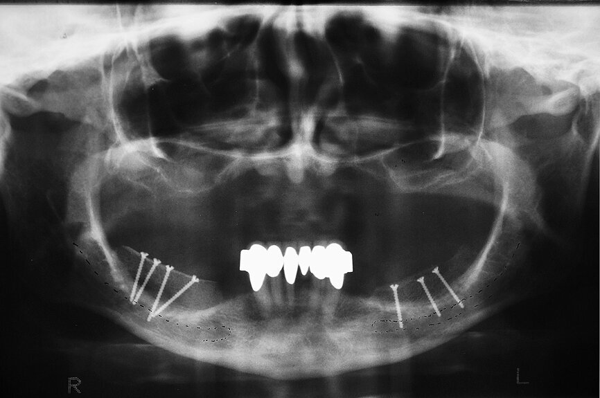 Fig. 2 : Tomographie panoramique dentaire après chirurgie d’augmentation par une greffe osseuse de crête iliaque. 