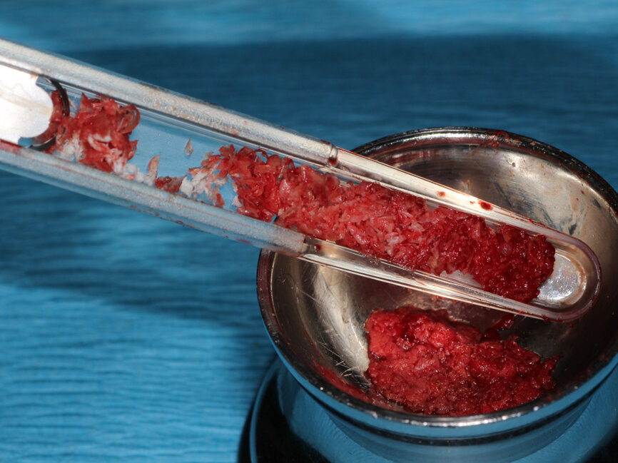 Fig. 7: Autogenous bone that was harvested with the mx-grafter (Maxilon, Hollis, N.H.) from the posterior lateral aspect of the mandible is placed into a sterile mixing dish.