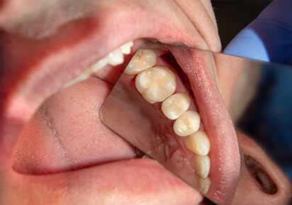 Protilab – Full Zircone