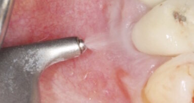 İmplant Sıkıntılarından İmplantın Nirvanasına