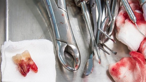 Studi odontoiatrici senza protocolli di protezione dagli agenti patogeni ematici