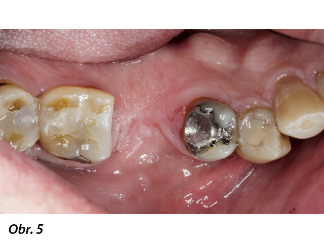 Okluzní pohled na oblast 46.