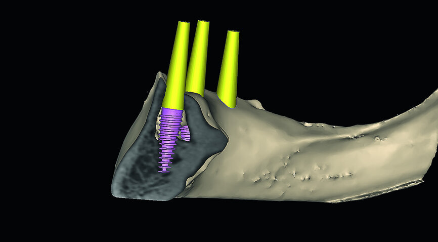 Fig. 11b: The ‘clipping’ view with simulated implants reveals ‘hollow’ areas in the symphysis.