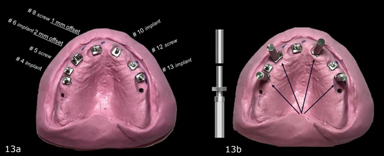 Figs. 13a & b: Putty base with the corrected lower parts of the two-piece guide posts replacing the 2 mm straight guide posts for the planned sites for the implants and fixation screws inserted (a). Straight and uncorrected guide posts in the sites of the maxillary right second premolar, right first premolar, left first premolar and left second premolar. Offset guide posts in the sites of the right canine and right central incisor. Angle-corrected guide post in the site of the left lateral incisor (b).