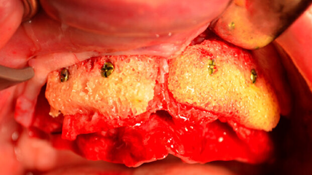 Madrid 2-3 giugno 2016: seminario di approfondimento formativo teorico-pratico di alta chirurgia su dissezione anatomica