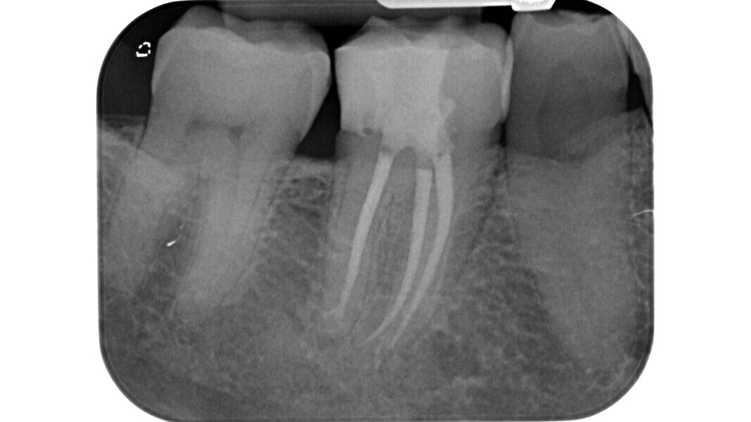 Fig. 20 : Radiographie postopératoire.
