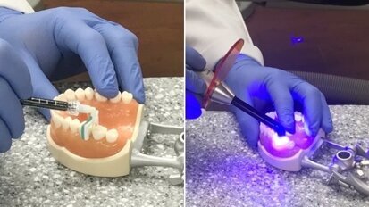 Procuram-se participantes para ensaio de tratamento indolor de cáries