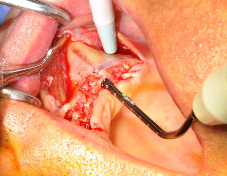 Figg. 11-14 - Preparazione finale.