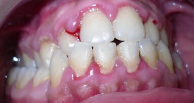 Valutazione clinica  degli effetti del prodotto a base di aminoacidi combinato con sodio jaluronato (aminogam) in pazienti sottoposti a igiene orale professionale